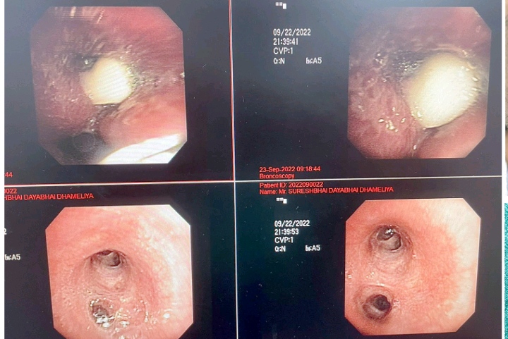 ખેંચ આવતા છ દાંતનું ચોકઠું શ્વાસનળીમાં ચાલ્યું ગયું, બ્રોન્કોસ્કોપીથી બહાર કાઢયું